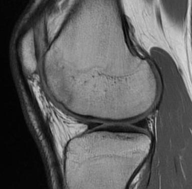 Knee Healed OCD Post Drilling